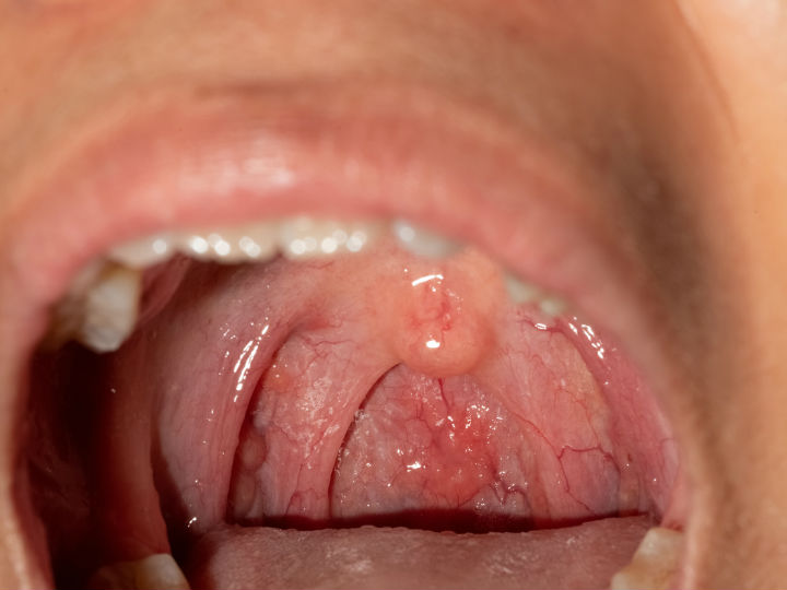 Cancer bucal imagenes Vph en la boca primeros sintomas