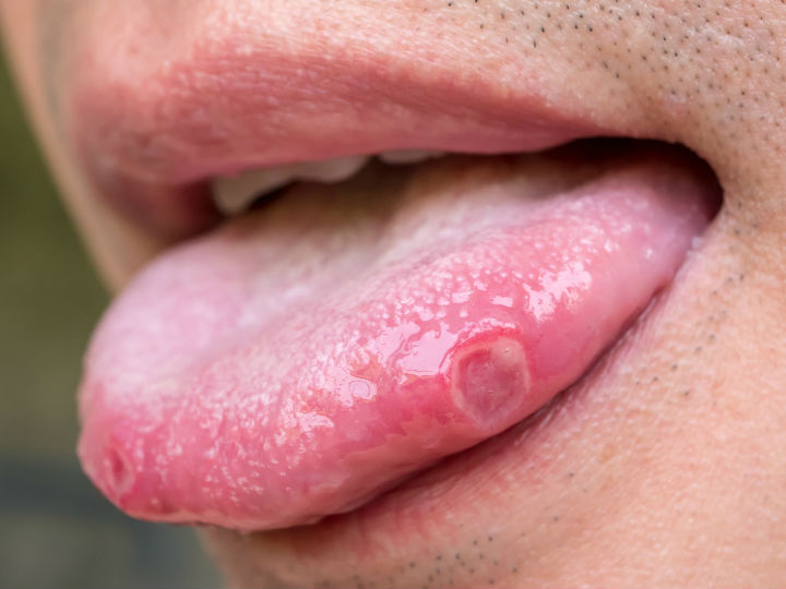 Papiloma virus en la boca - Virus y cavidad oral: Virus del Papiloma Humano hpv qui persiste