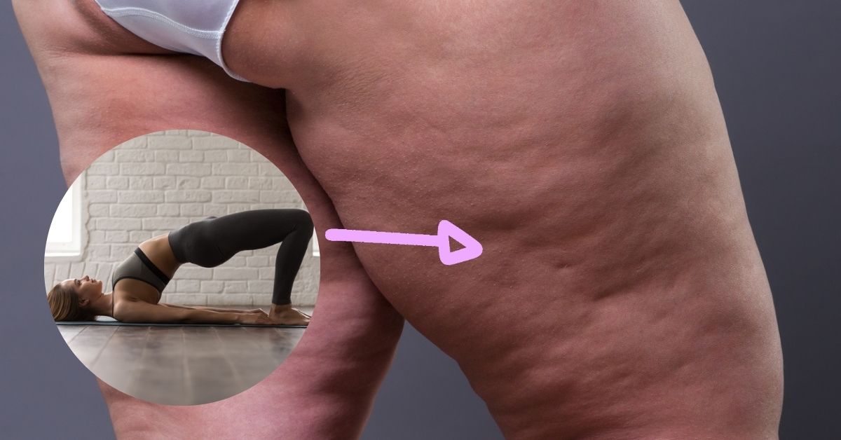 Tecnología Anónimo estimular 8 ejercicios que pueden ayudar a reducir el lipedema en tus piernas ("la  otra celulitis")