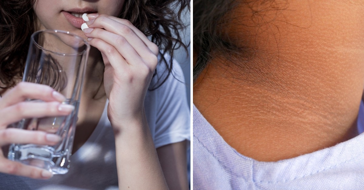 Qué es la acantosis nigricans: 4 causas de las manchas negras en cuello,  axilas e ingle