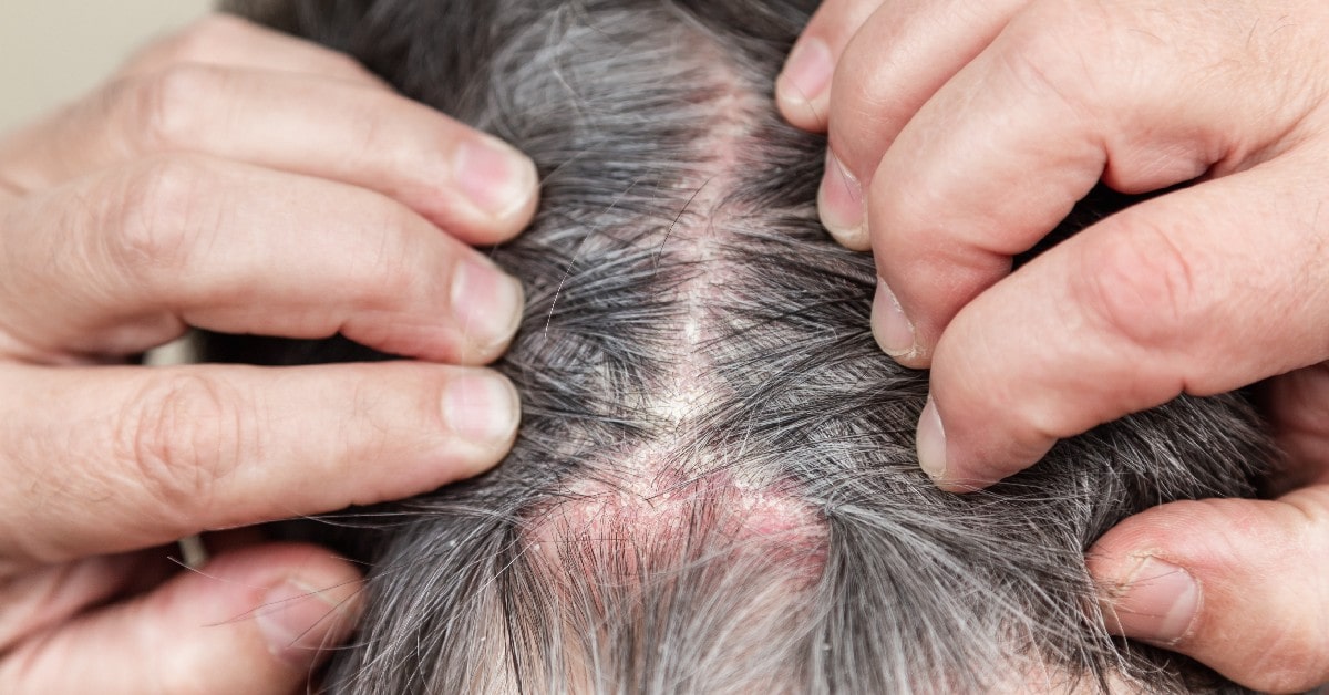 Irritación en el cuero cabelludo: saber si es caspa o una enfermedad?