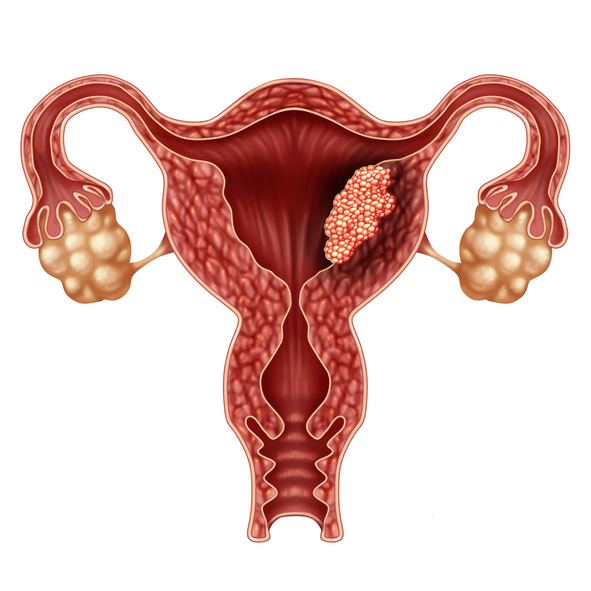 Sintomas de pólipos uterinos
