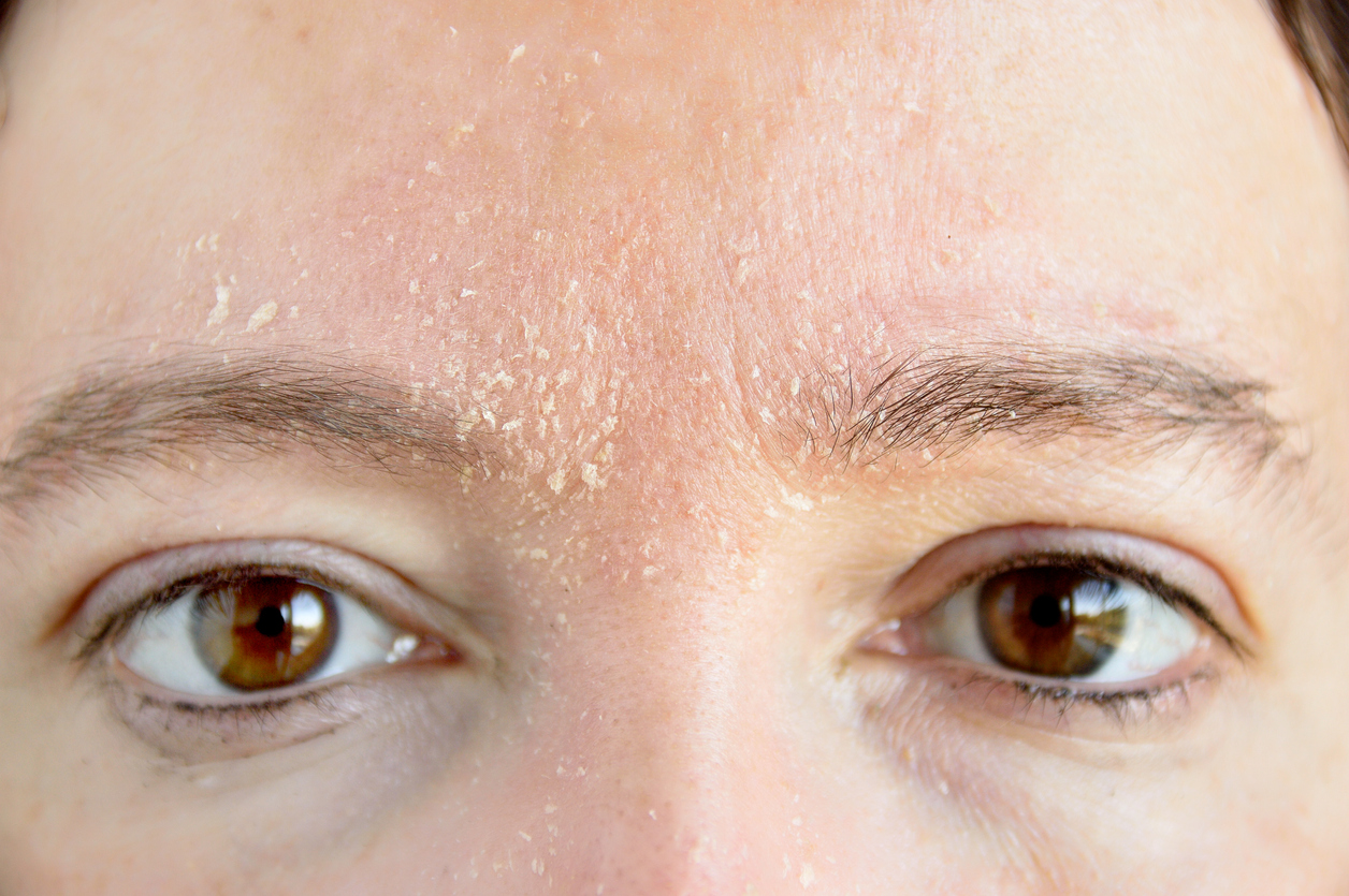 dermatite seborr a szem alatt vörös foltok hámlanak le mint kezelni