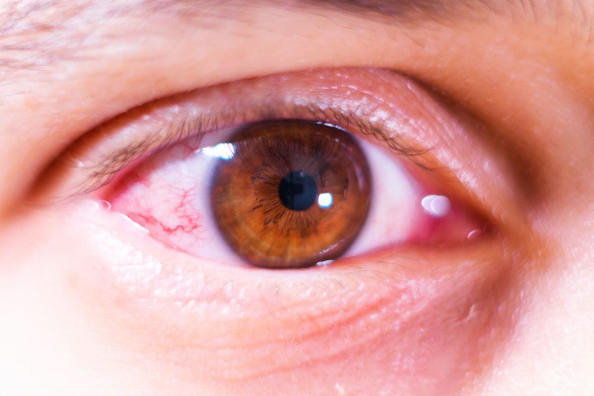 Ojo rojo de persona para ilustrar cómo aliviar el ojo seco