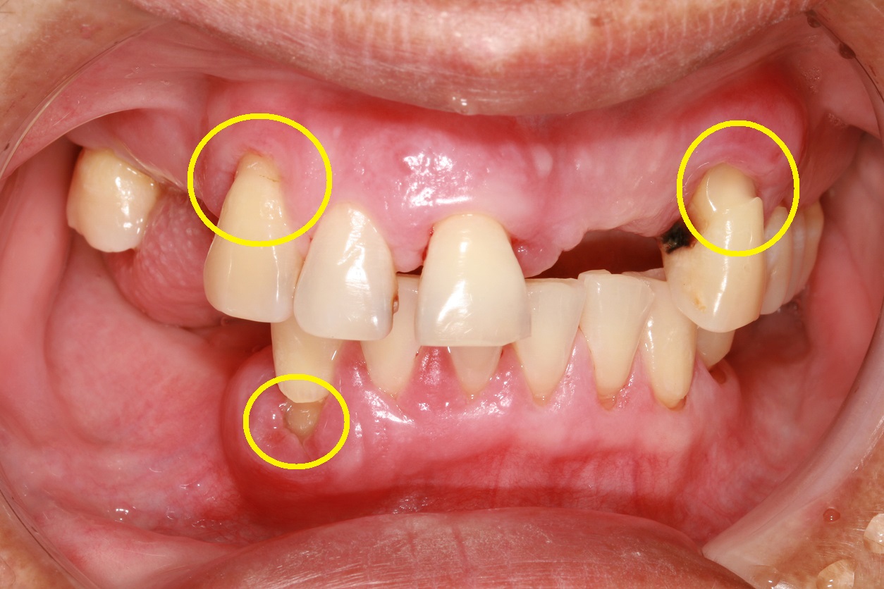 3 señales de que cepillas tus dientes con mucha fuerza y destruyes el tejido de las encías
