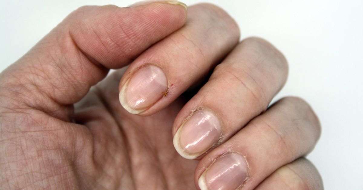 Por qué aparecen las estrías en las uñas y cómo prevenirlas  ACIR Online