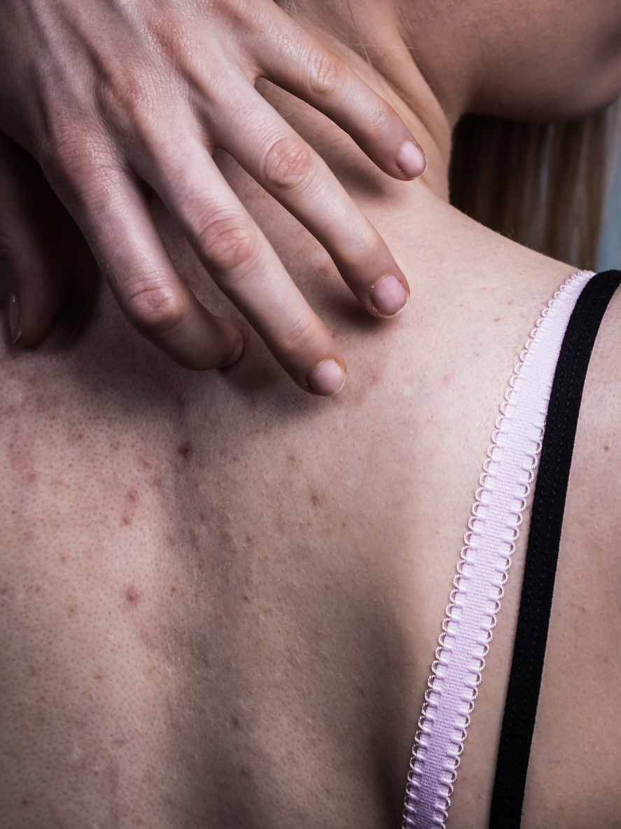 Mujer con acné en la espalda