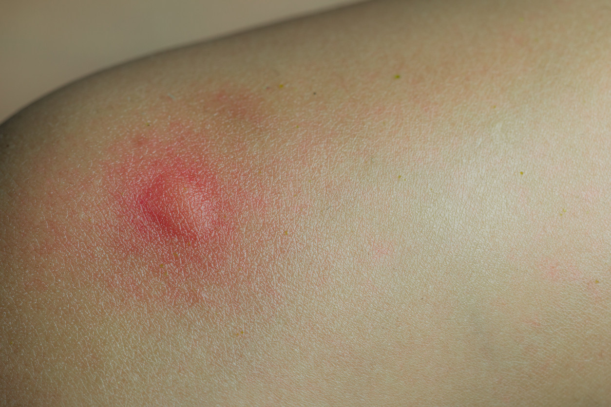 Esto es lo que en realidad pasa en tu cuerpo cuando te pica un mosquito
