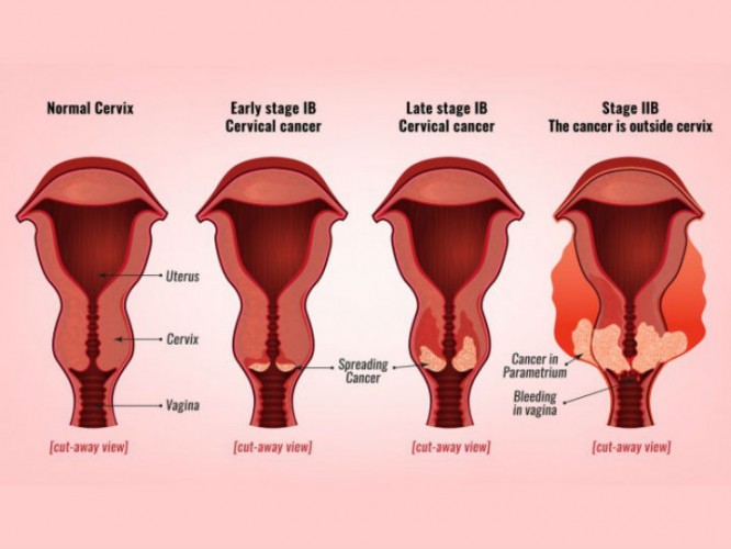 Sangrado en la menstruación por cáncer de útero