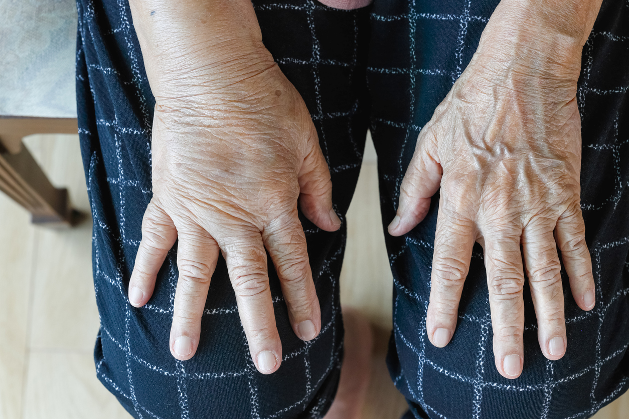 Por qué se hinchan los dedos de las manos | Salud180
