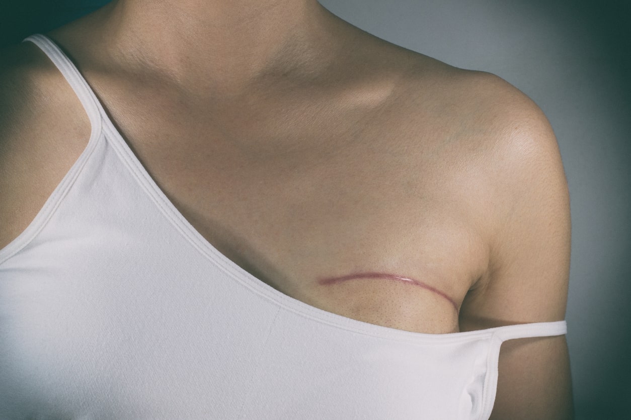 Mujer mostrando cicatriz de cirugía de seno por cáncer de mama
