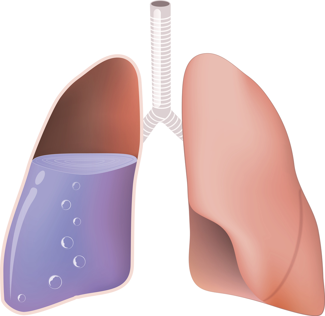 Síndrome pulmonar por hantavirus: la enfermedad que se relaciona con los ratones