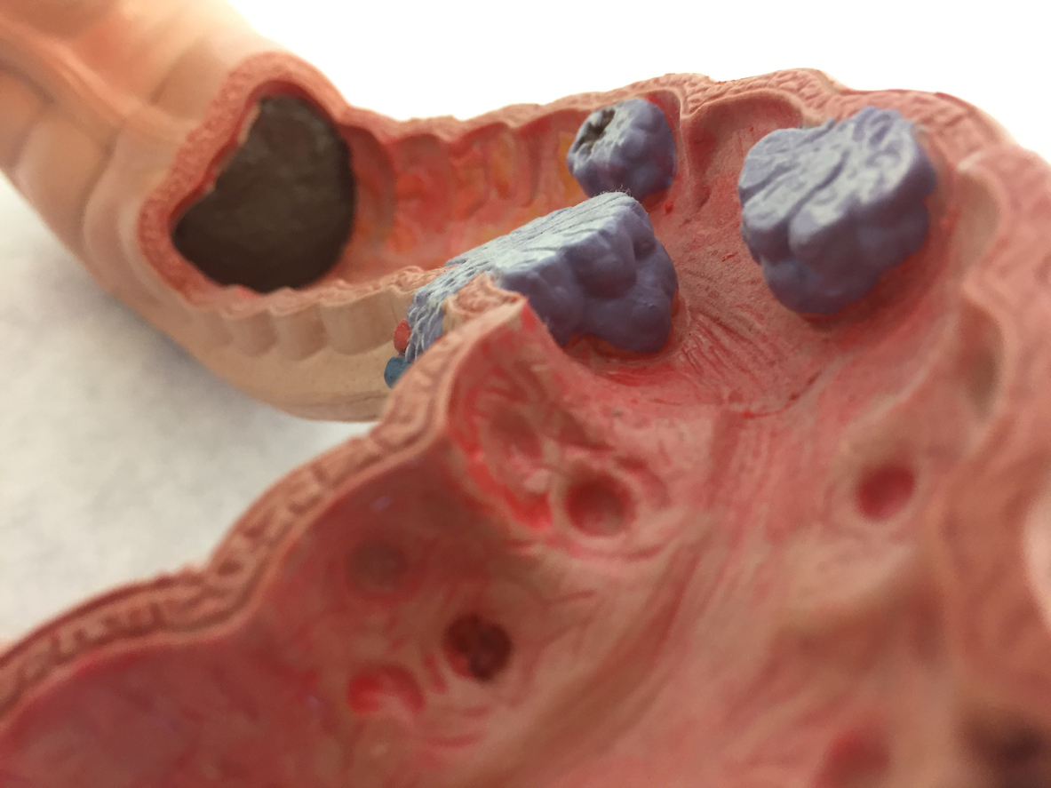 Diverticulitis alrededor del colon pueden causar una obstrucción intestinal