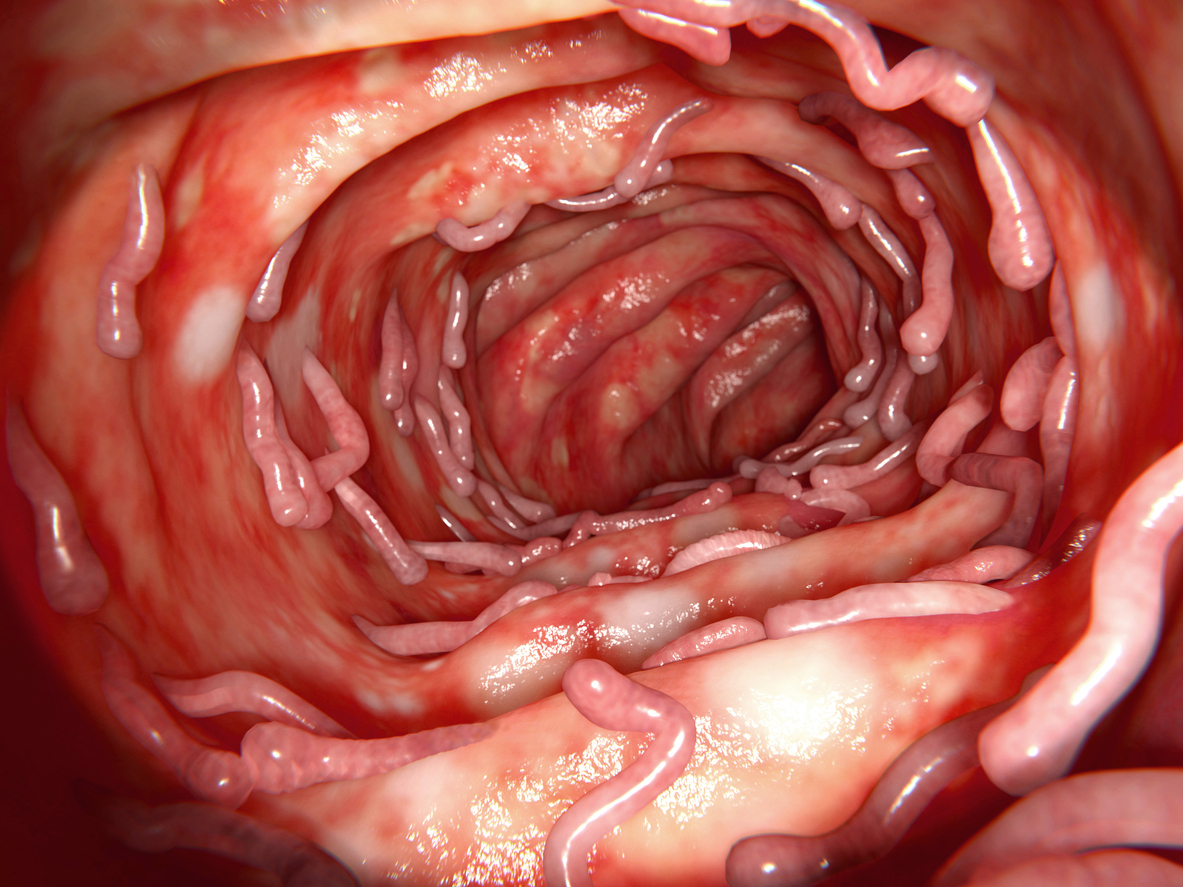 ¿Qué causa una perforación gastrointestinal? 4 padecimientos que pueden ser preocupantes