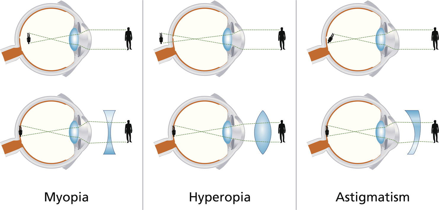 Tipos de problemas visuales, miopía, astigmatismo