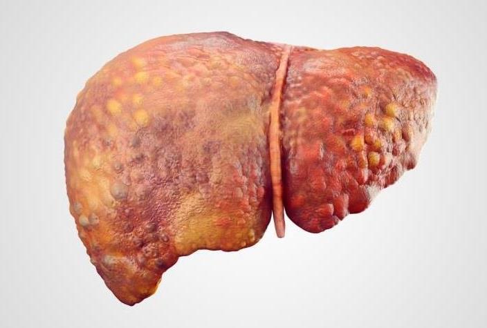 El hígado graso puede provocar cirrosis o cáncer de hígado