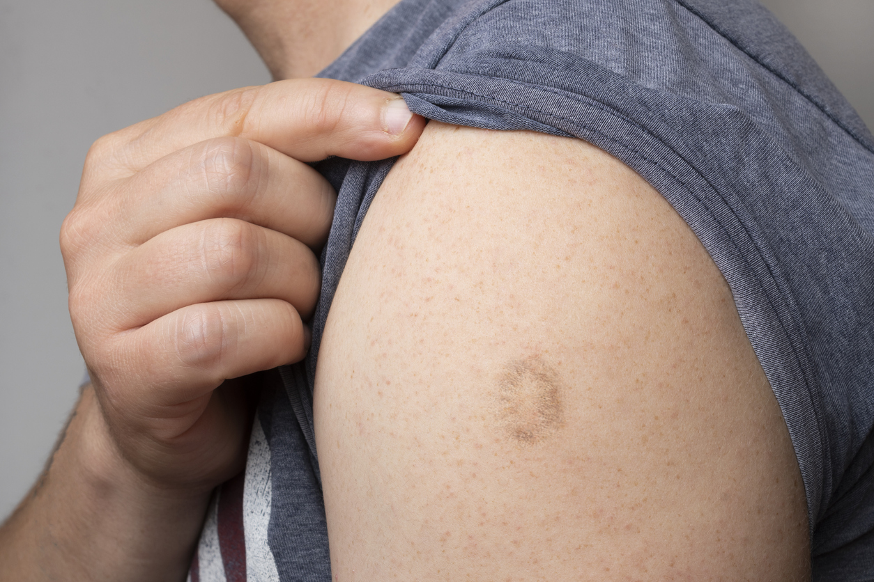 Cicatriz en el brazo por vacuna de la viruela