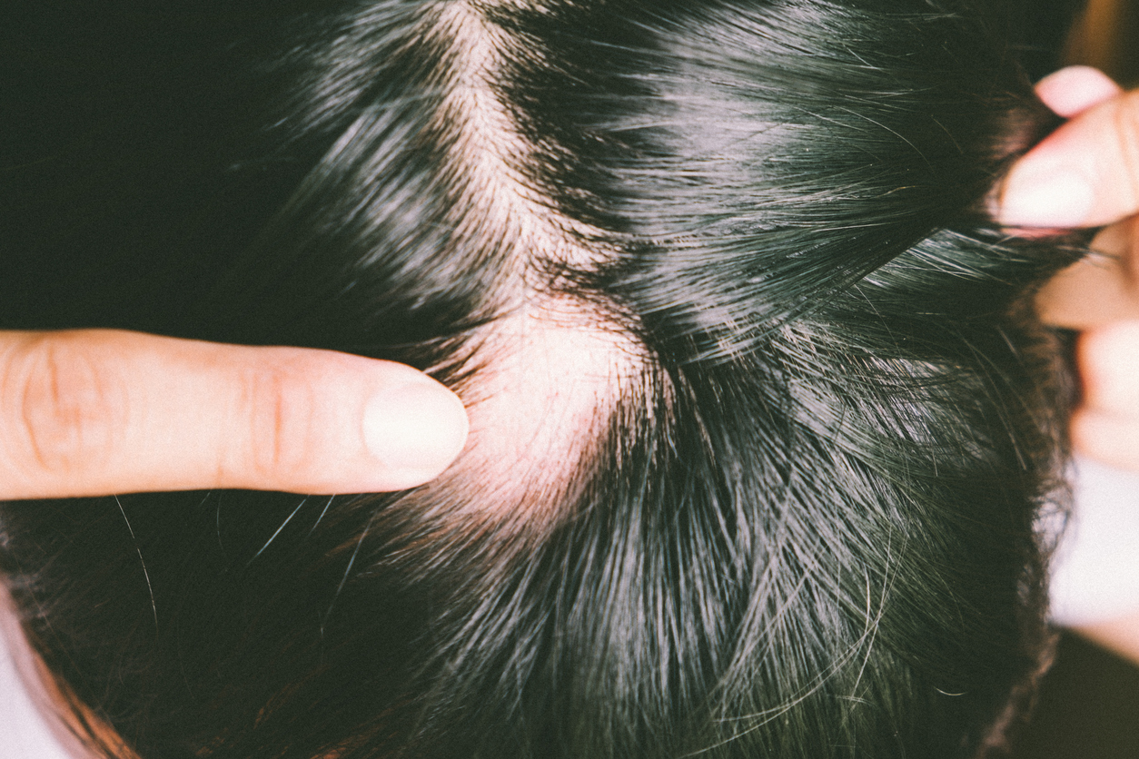 De acuerdo con especialistas de Mayo Clinic, cuando las células del sistema inmune atacan la raíz del cabello y la destruye generando una caída anormal, en la cabeza, una o más zonas en forma circular presentan calvicie, médicamente se le conoce como alop