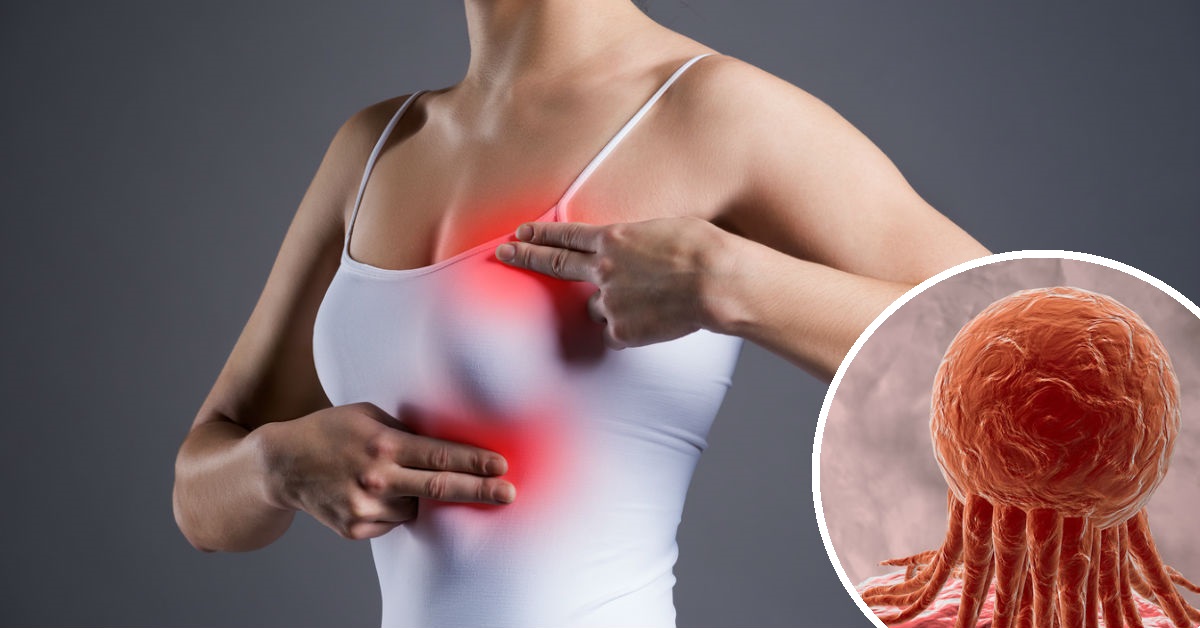 Los fibroadenomas también es uno de los síntomas más comunes cuando se presenta dolor o punzadas en los senos
