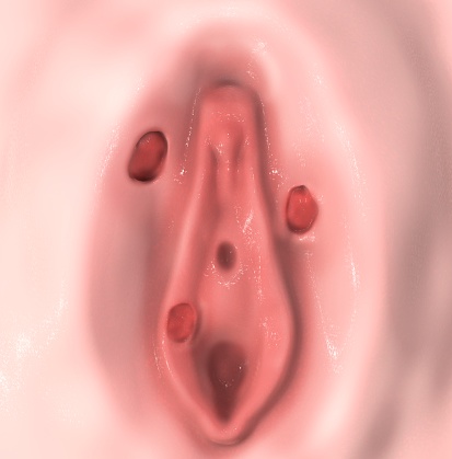 Úlceras en la vagina