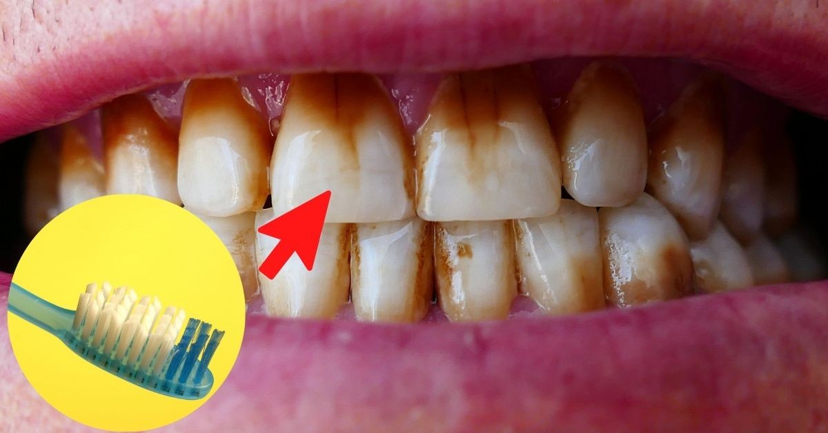 Gérmenes en cepillo de dientes y daños a los dientes por usarlo sin cambiarlo cada 3 meses
