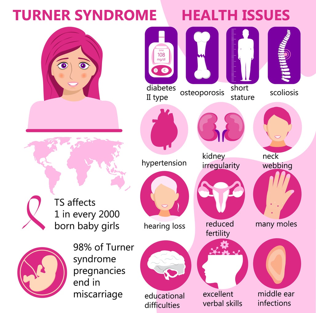 Infografía mostrando características y complicaciones del síndrome de Turner