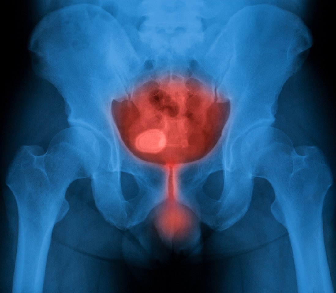  Padecer de cistitis o inflamación de las vías urinarias aumenta el riesgo de desarrollar cáncer de vejiga
