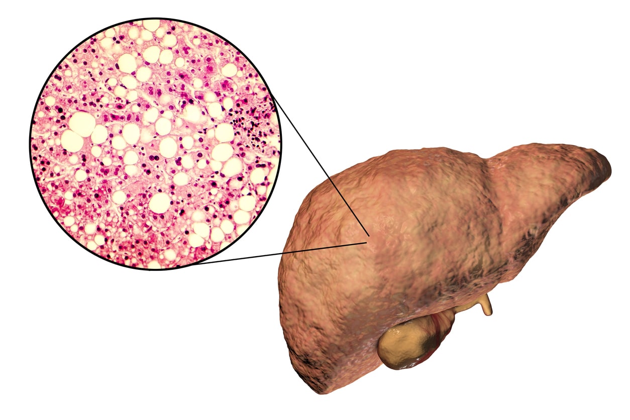 Ilustración mostrando el hígado graso y esteatosis hepática