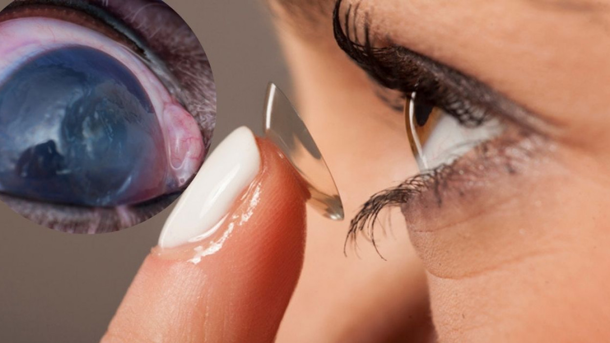 abolir sueño Patriótico Lavar tus lentes de contacto con agua de garrafón: hábito que llena tus  ojos de 'seres' nada inofensivos