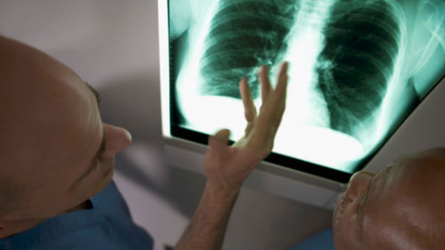 VPH podría estar asociado a cáncer de pulmón.