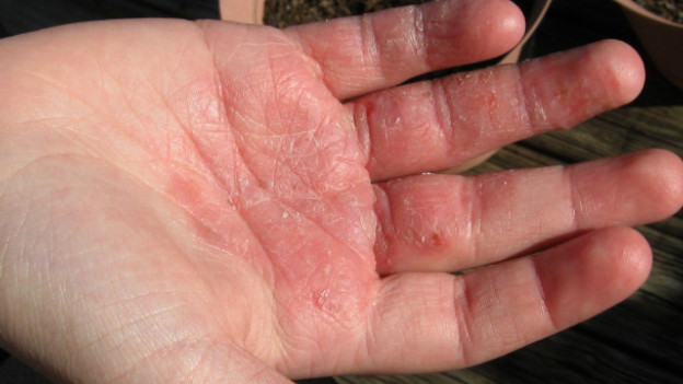 Eczema y la dermatitis atópica afectan a todos por igual