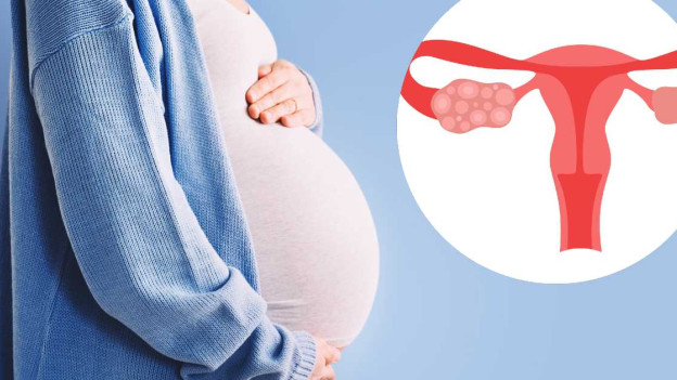 mujer embarazada e ilustración de síndrome de ovario poliquístico