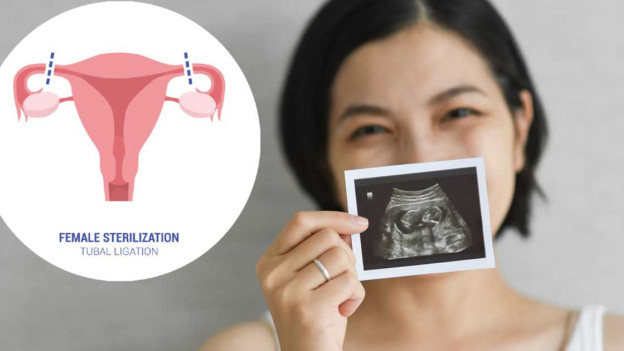 Ilustración ligadura de trompas de Falopio/ Mujer mostrando ultrasonido de embarazo