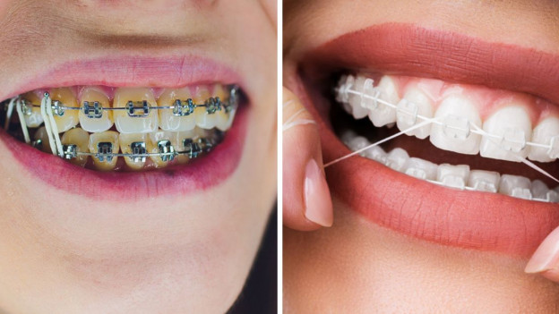 Diferentes tipos de brackets con el hilo dental. 