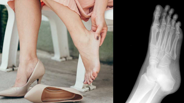 Mujer con dolor de pie por tacones / radiografía pie