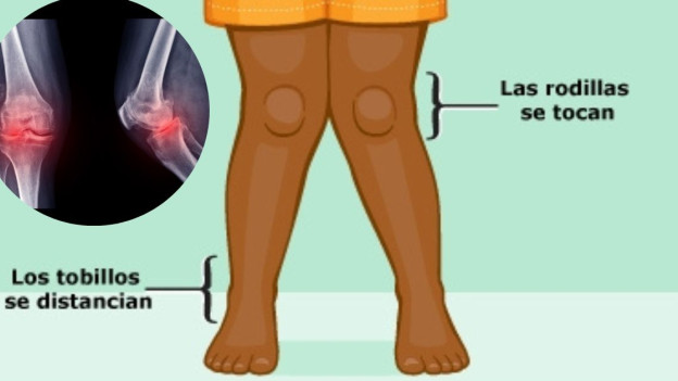Ilustración de rodillas o piernas X