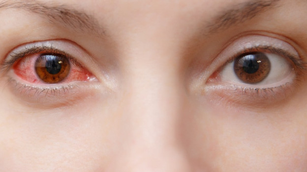 Persona con infección en un ojo.