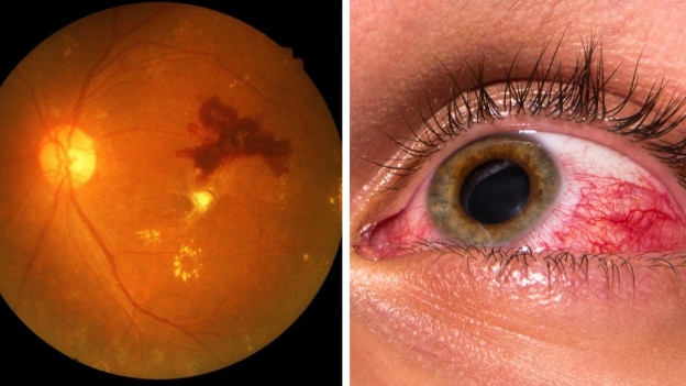 Oclusión en la arteria de la retina por colesterol alto