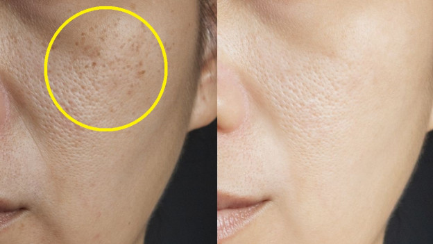 Mujer con manchas en la piel por sol antes y después