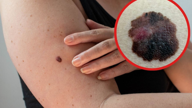 Mujer lunar con cáncer de piel 