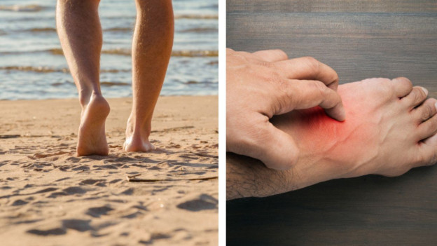 Persona caminando descalzo en la playa, hombre con irritación en el pie por quemadura