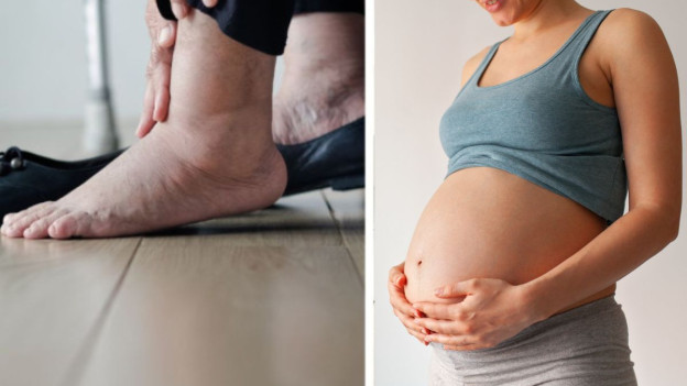 Persona con pies hinchados, mujer embarazada para explicar por qué los pies crecen con el embarazo