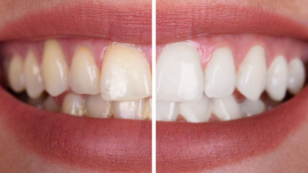 Mujer con sarro en los dientes antes y depués