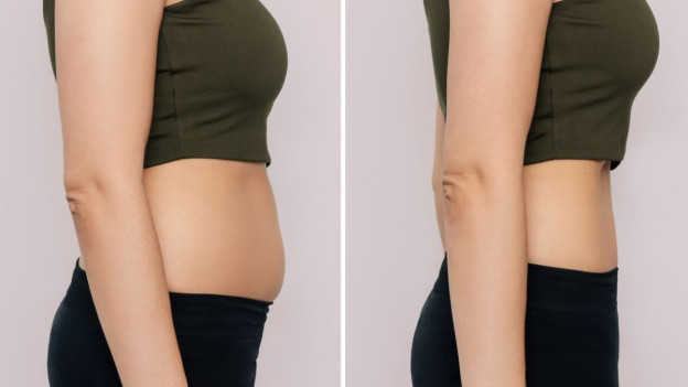 Mujer con inflamación abdominal antes y después