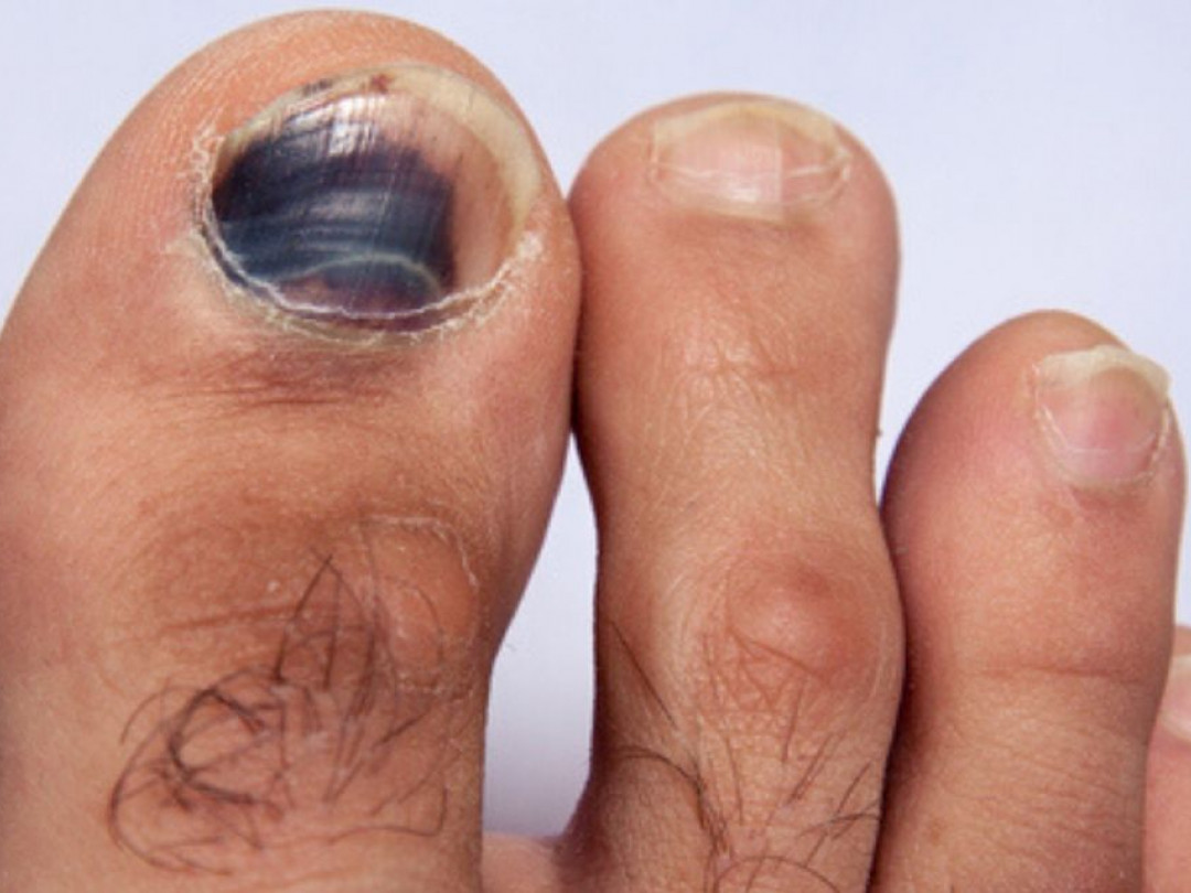 4 formas de curar una uña del pie morada rápidamente