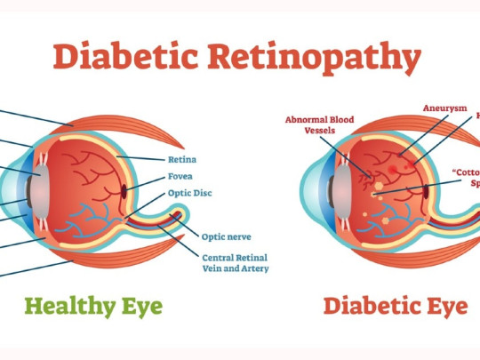 Comparación del ojo normal y el ojo con retinopatía diabética.