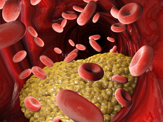 Ilustración de colesterol en las arterias 