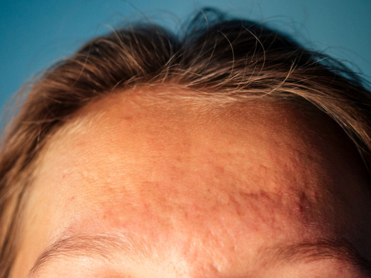 Mujer con cicatrices de varicela en la frente