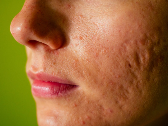 Mujer con cicatrices en el rostro
