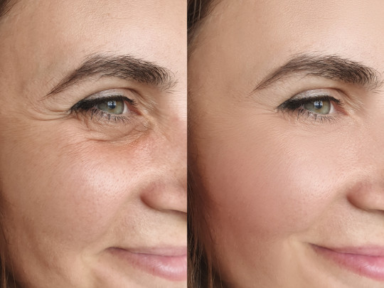 Mujer con arugas en la piel antes y después de usar ácido hialurónico